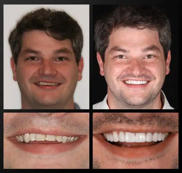 Smile-On-Dental-Studio-Patient-Before by Hill Dental Acquisitions LLC, DBA Smile On Dental Studio in Richmond Heights, MO