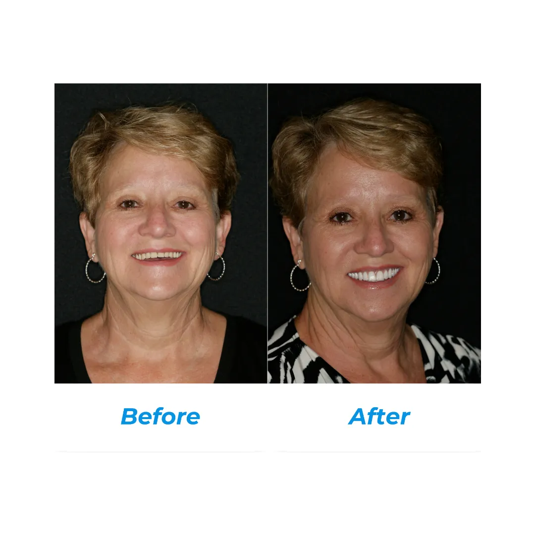 IMPLANT DENTURES One by Hill Dental Acquisitions LLC, DBA Smile On Dental Studio in Richmond Heights, MO