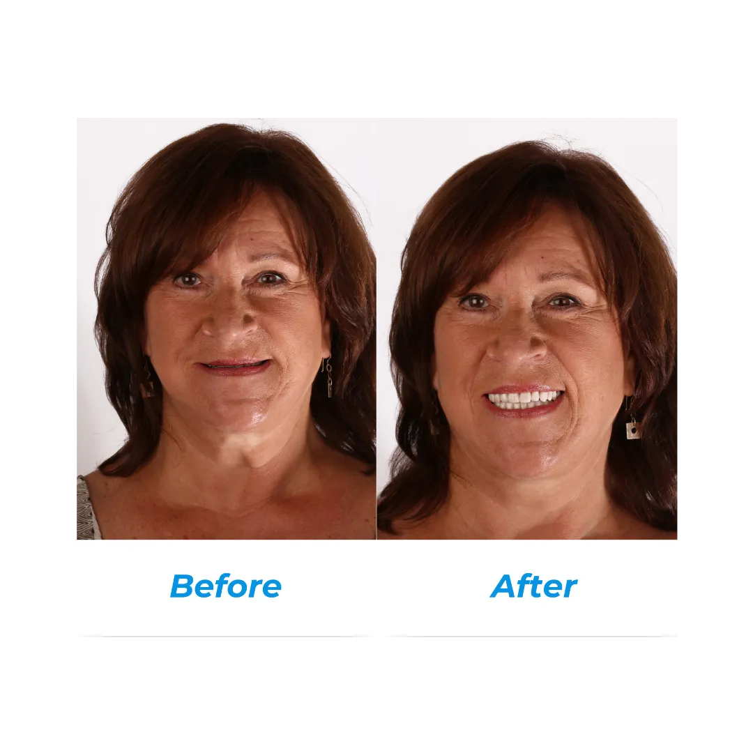 IMPLANT DENTURES three by Hill Dental Acquisitions LLC, DBA Smile On Dental Studio in Richmond Heights, MO