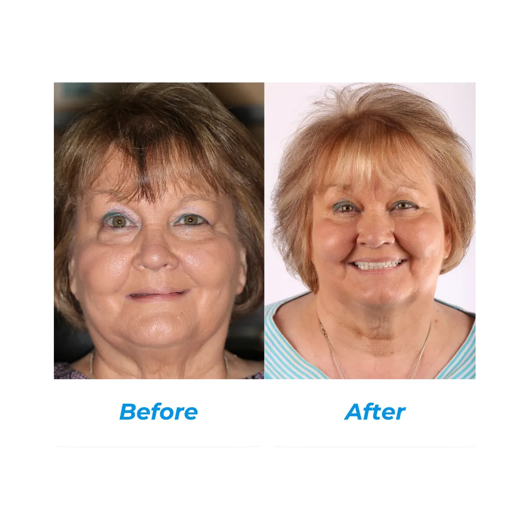 IMPLANT DENTURES Two by Hill Dental Acquisitions LLC, DBA Smile On Dental Studio in Richmond Heights, MO