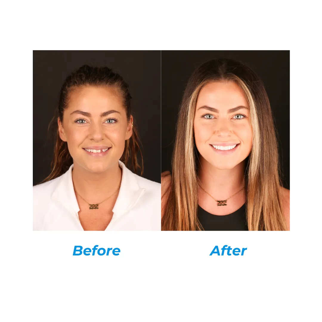 TOOTH REPLACEMENT One by Hill Dental Acquisitions LLC, DBA Smile On Dental Studio in Richmond Heights, MO