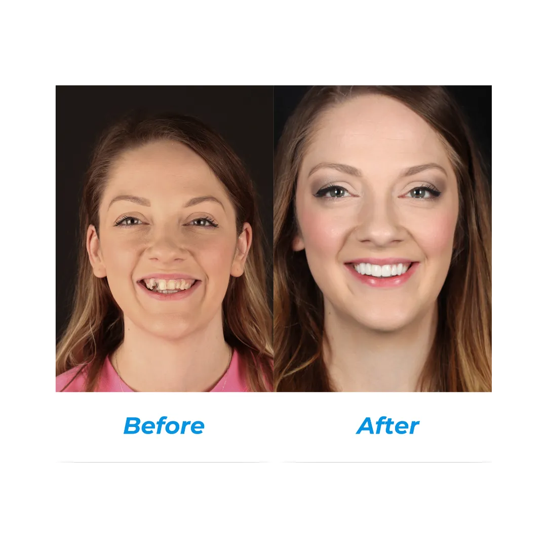 TOOTH REPLACEMENT Two by Hill Dental Acquisitions LLC, DBA Smile On Dental Studio in Richmond Heights, MO